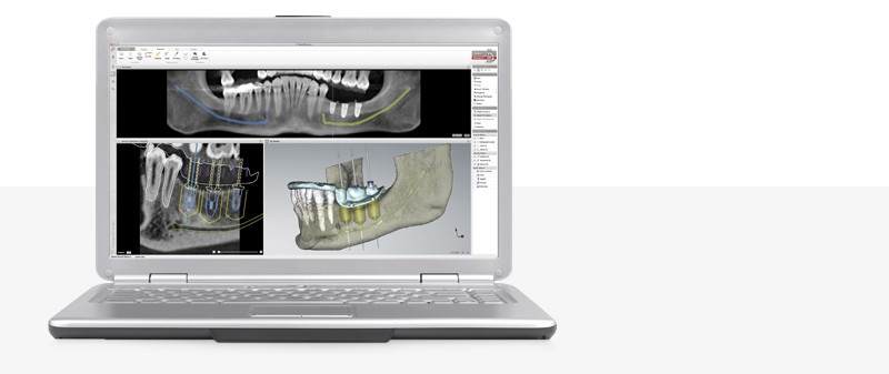 3D-Planung von Zahnimplantaten auf Laptop-Bildschirm.