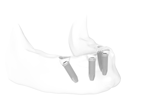 3D-Darstellung von Zahnimplantaten im Unterkiefer.