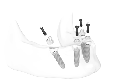 3D-Darstellung von Zahnimplantaten im Kieferknochen.