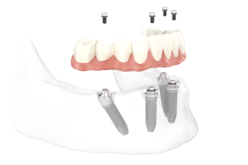 3D-Darstellung des All-on-4-Implantatsystems im Kiefer.